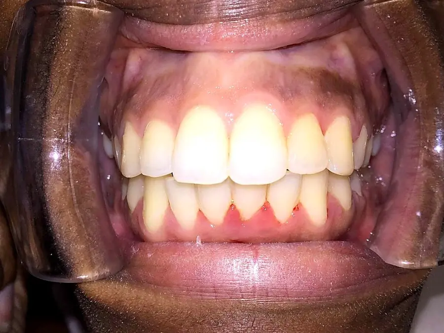 Case 1 after: lower front teeth aligned