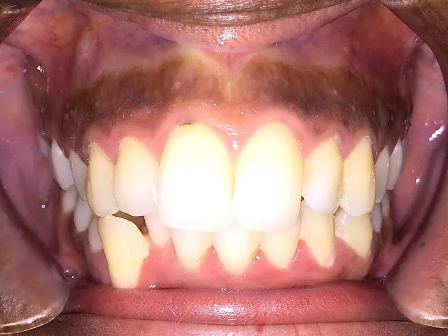Case 1 before: crowded, rotated lower front teeth