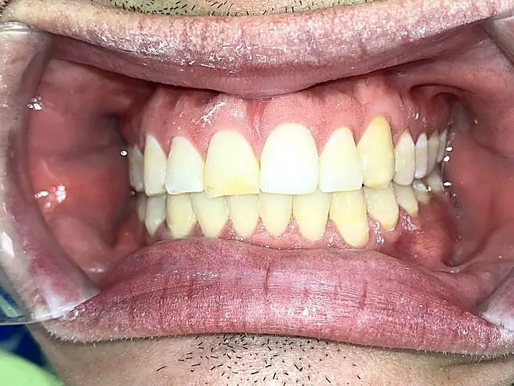 Case 2 after: teeth aligned in an even arch