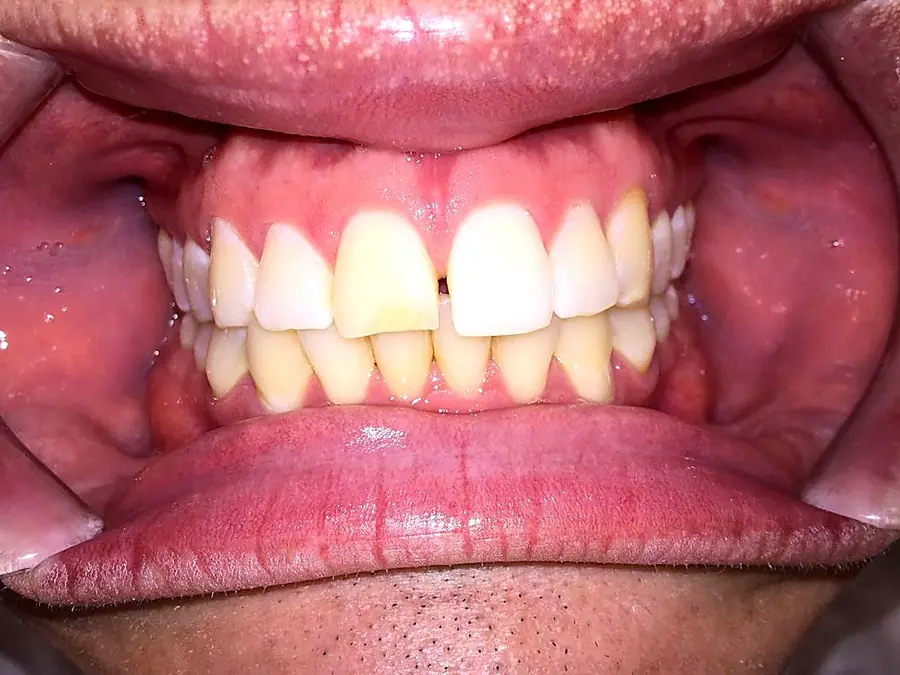 Case 2 before: overlapping, crowded teeth