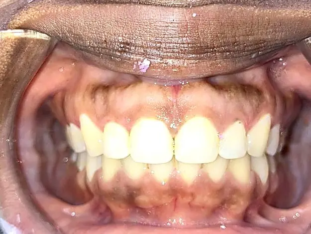 Case 3 after: upper and lower teeth aligned