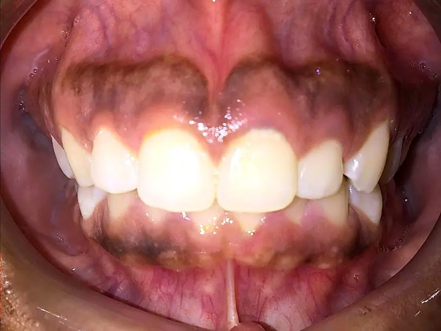 Case 3 before: crowded upper and lower teeth