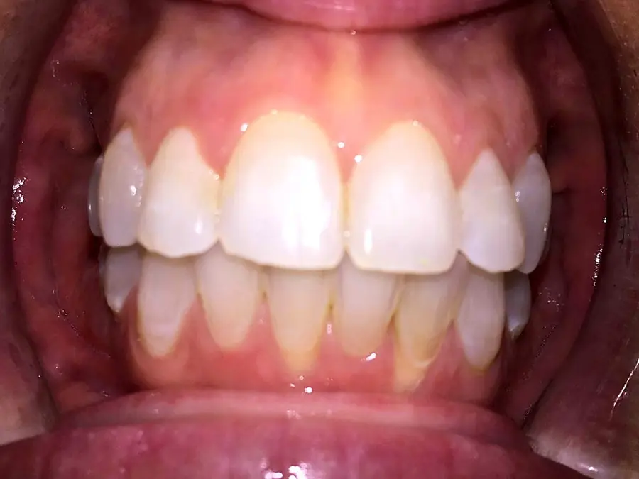 Case 4 after: teeth aligned