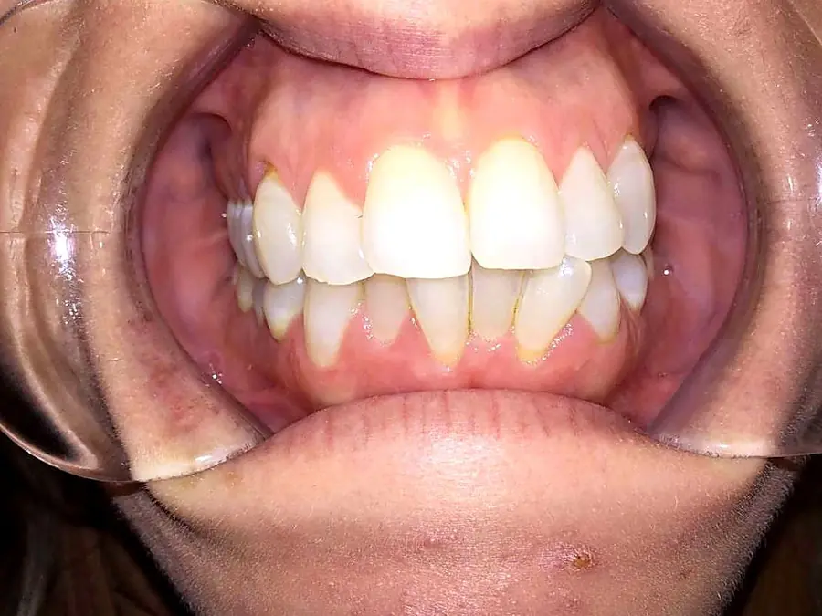 Case 4 before: uneven, crowded teeth