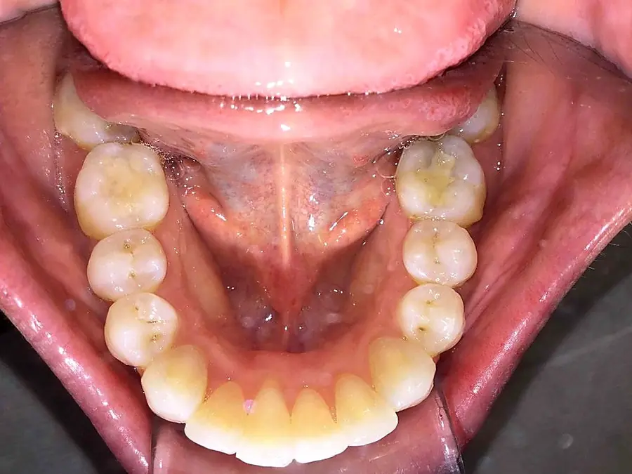 Case 5 after: lower arch aligned