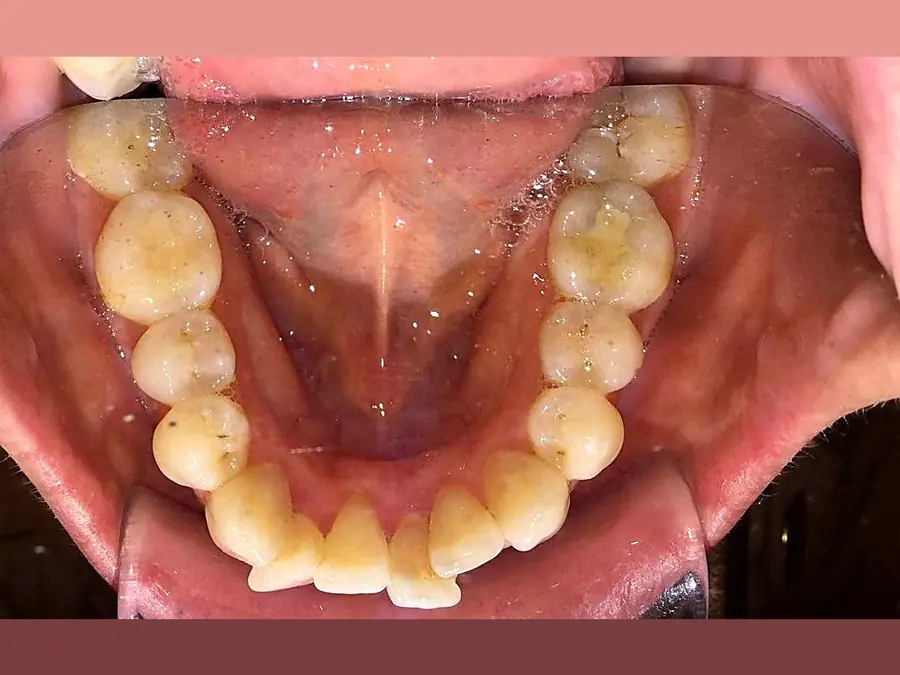 Case 5 before: crowded lower arch